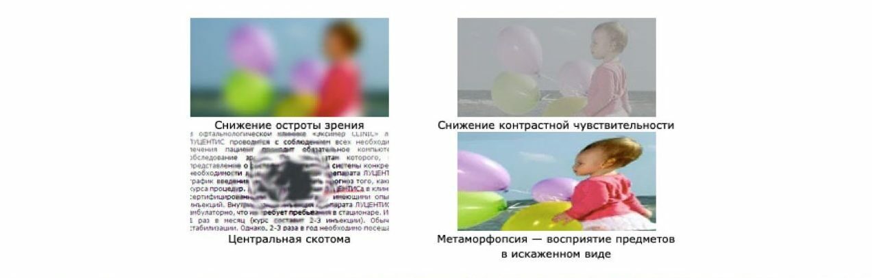 Симптомы «влажной» формы ВМД